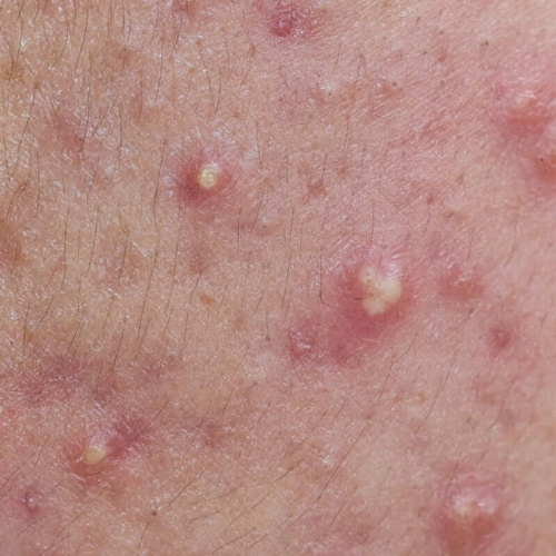 Mục đích chính của việc điều trị ổ mụn viêm dưới da là gì?
