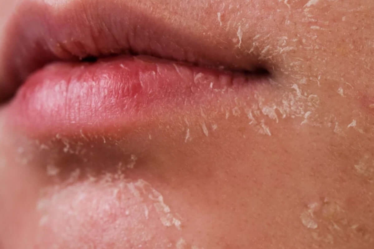 Làm thế nào để khắc phục da dầu bị khô bong tróc? | Dermalogica – Dermalogica Vietnam