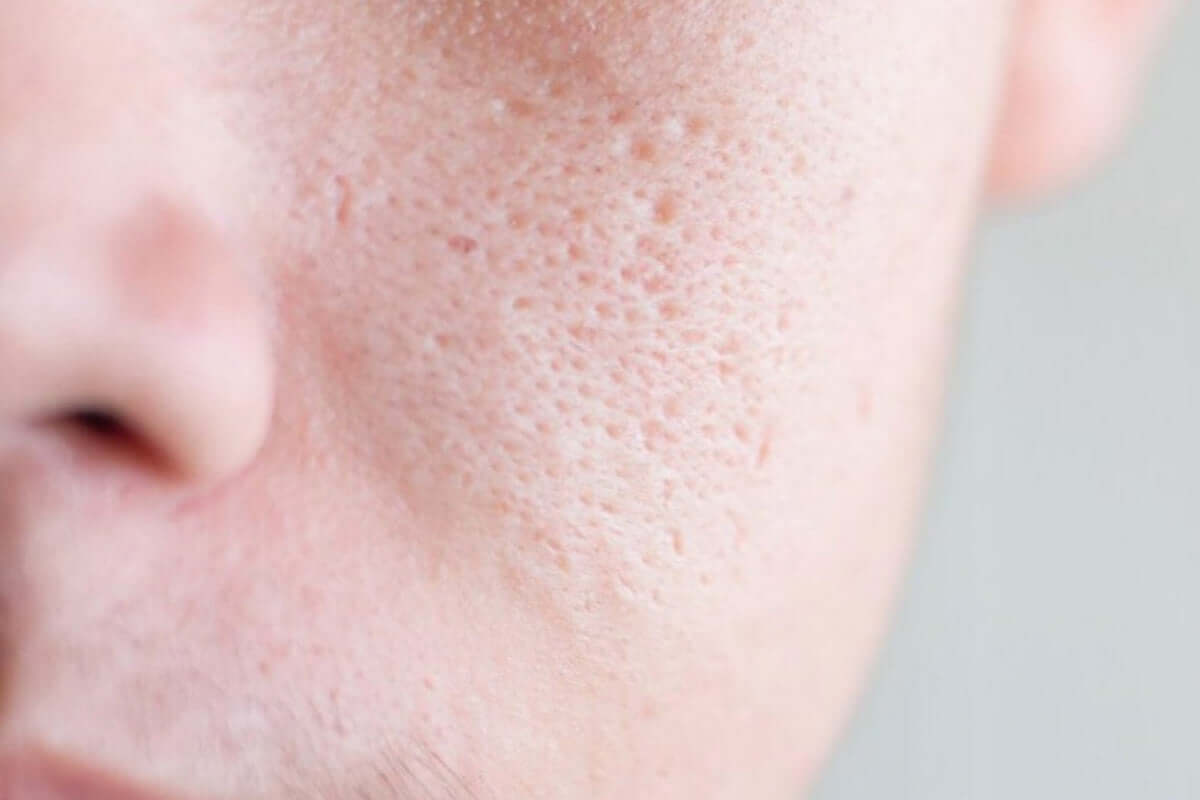 Tại sao lỗ chân lông to? Có thể đóng hoặc thu nhỏ lỗ chân lông không? – Dermalogica Vietnam