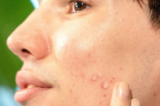 everything you need to know about acne scarring