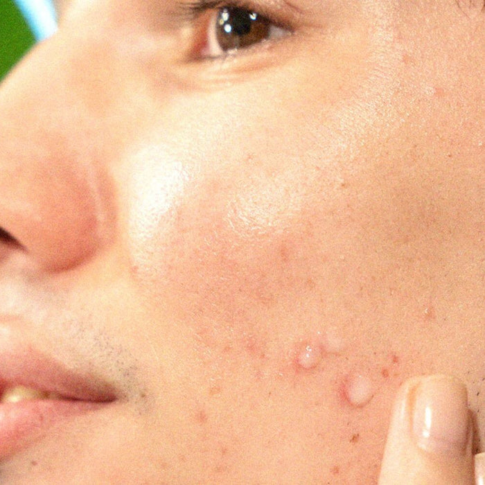 everything you need to know about acne scarring