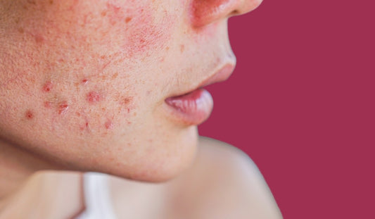 huong dan cach phuc hoi da bi ngua noi man do hieu qua nhat