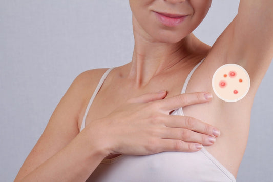 nguyen nhan bi mun o nach va cach tri mun moc o nach hieu qua tai nha