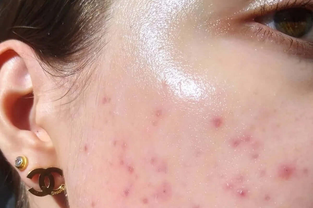 Vì sao điều trị mụn sai cách có thể làm hỏng hàng rào bảo vệ da?