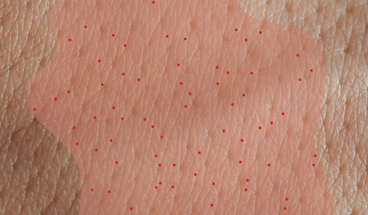 tai sao da bi viem nang long lo chan long? cach dieu tri viem lo chan long nang long