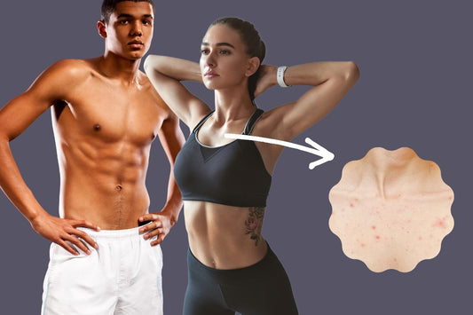 huong dan tri mun moc o nguc hieu qua tai nha