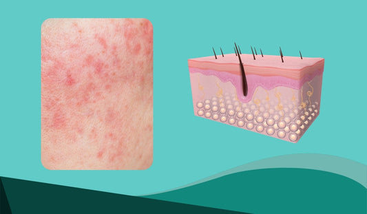 viem chan long la gi? cach ngan ngua viem lo chan long