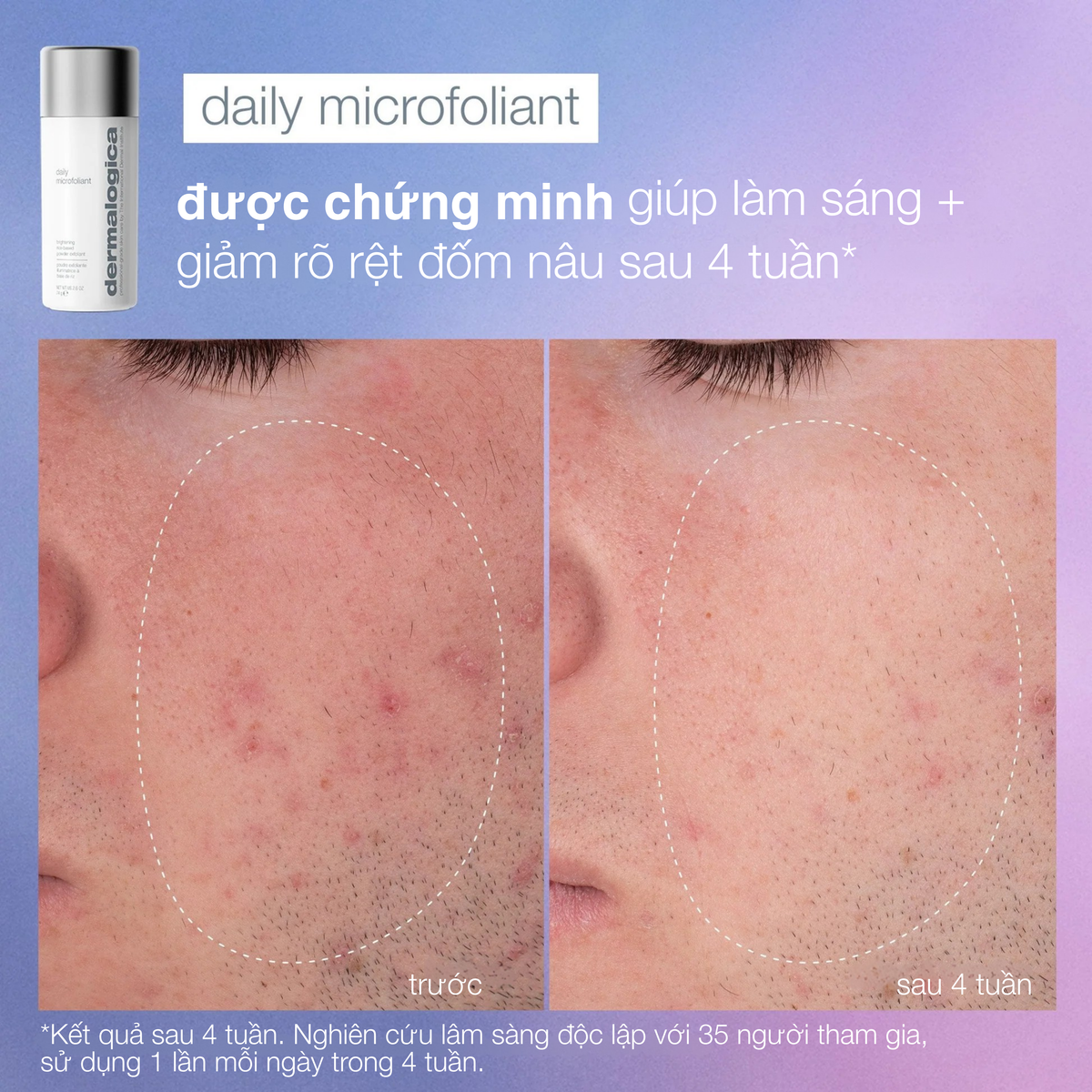 Chu trình chuyên gia tẩy da chết + rạng rỡ (bản giới hạn full-size + 2 dụng cụ chuyên nghiệp)