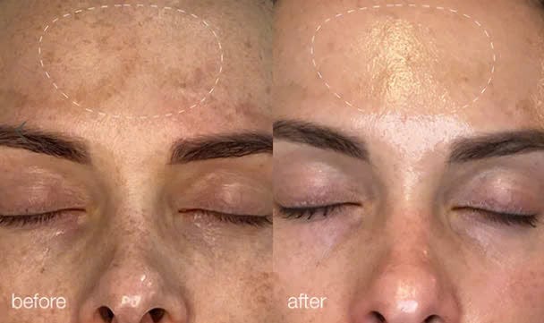 Dermalogica Vietnam 45 phút melanopro peel system treatment