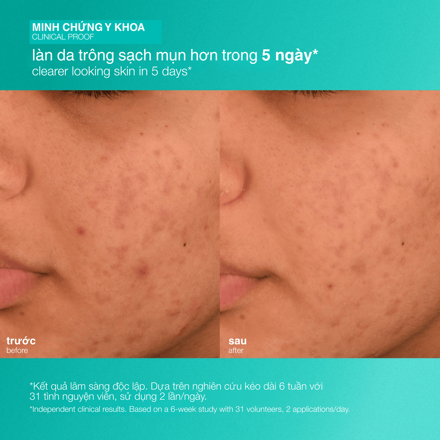 Dermalogica Vietnam MOISTURIZERS Fullsize 50ml dưỡng ẩm giảm mụn acne biotic moisturizer