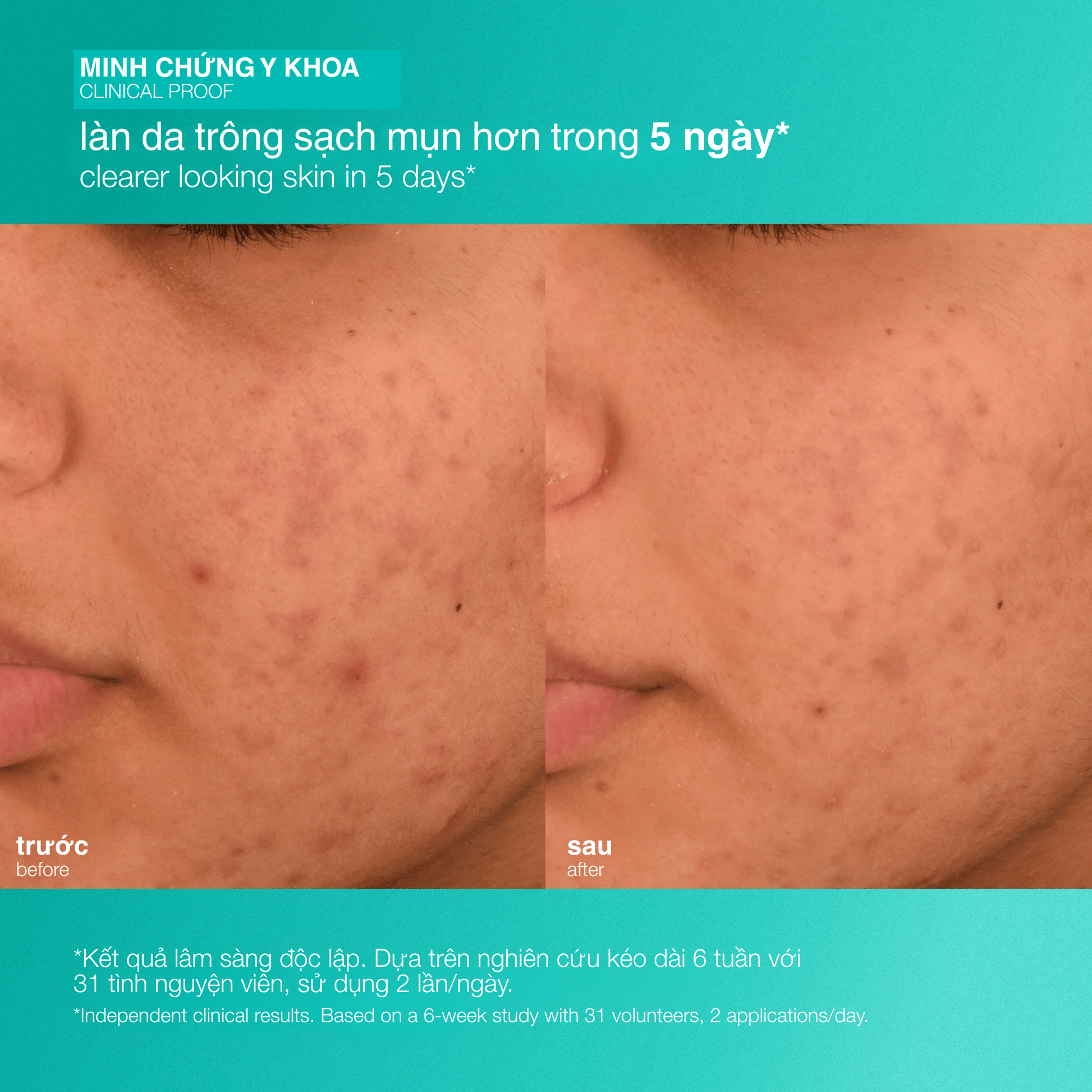 Dermalogica Vietnam MOISTURIZERS Fullsize 50ml dưỡng ẩm giảm mụn acne biotic moisturizer