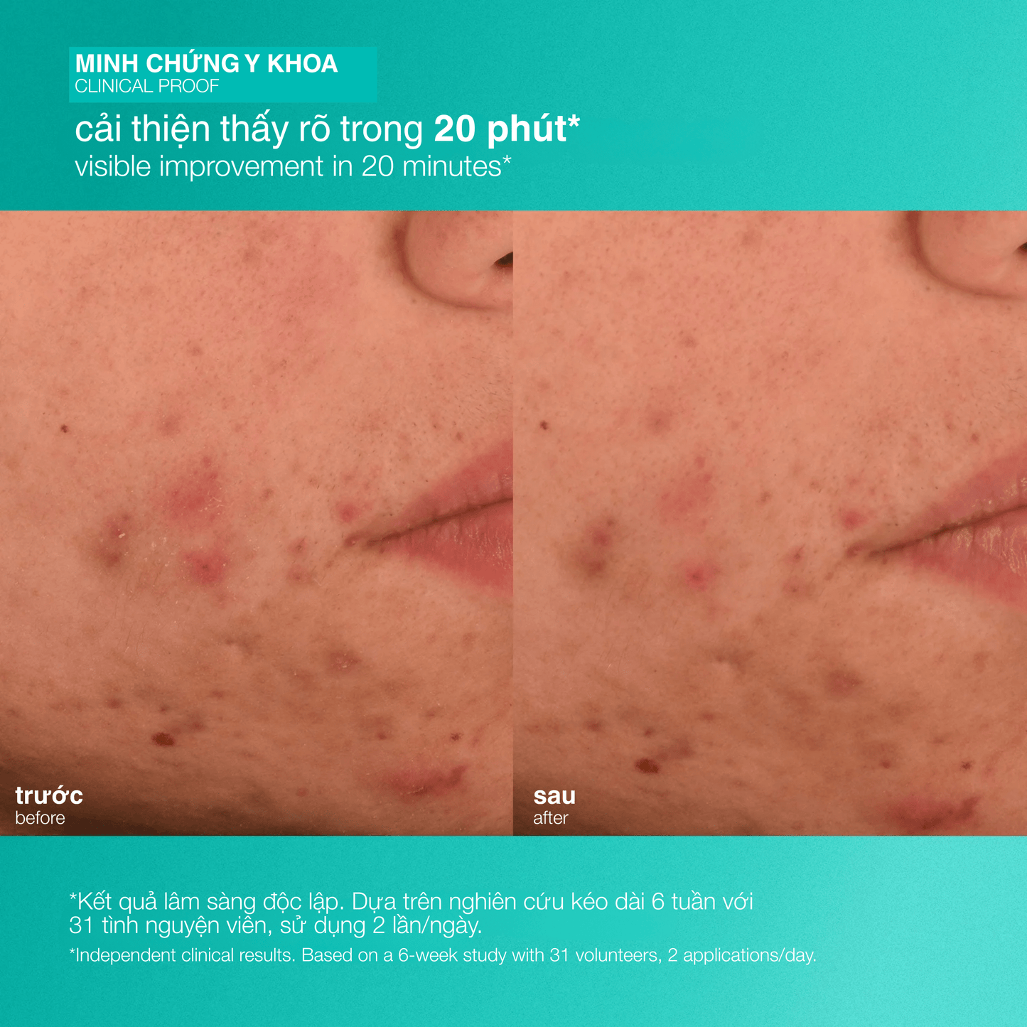 Dermalogica Vietnam MOISTURIZERS Fullsize 50ml dưỡng ẩm giảm mụn acne biotic moisturizer