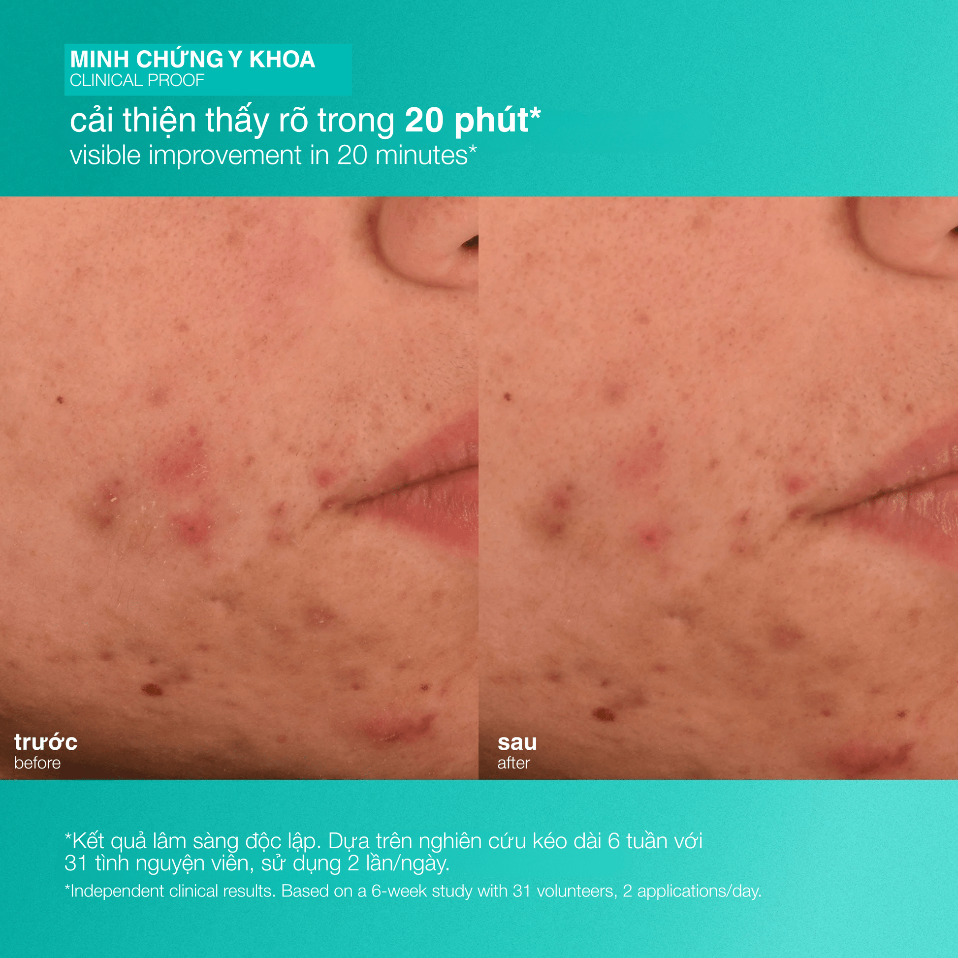 Dermalogica Vietnam MOISTURIZERS Fullsize 50ml dưỡng ẩm giảm mụn acne biotic moisturizer